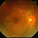 Central Serous Chorioretinopathy 1